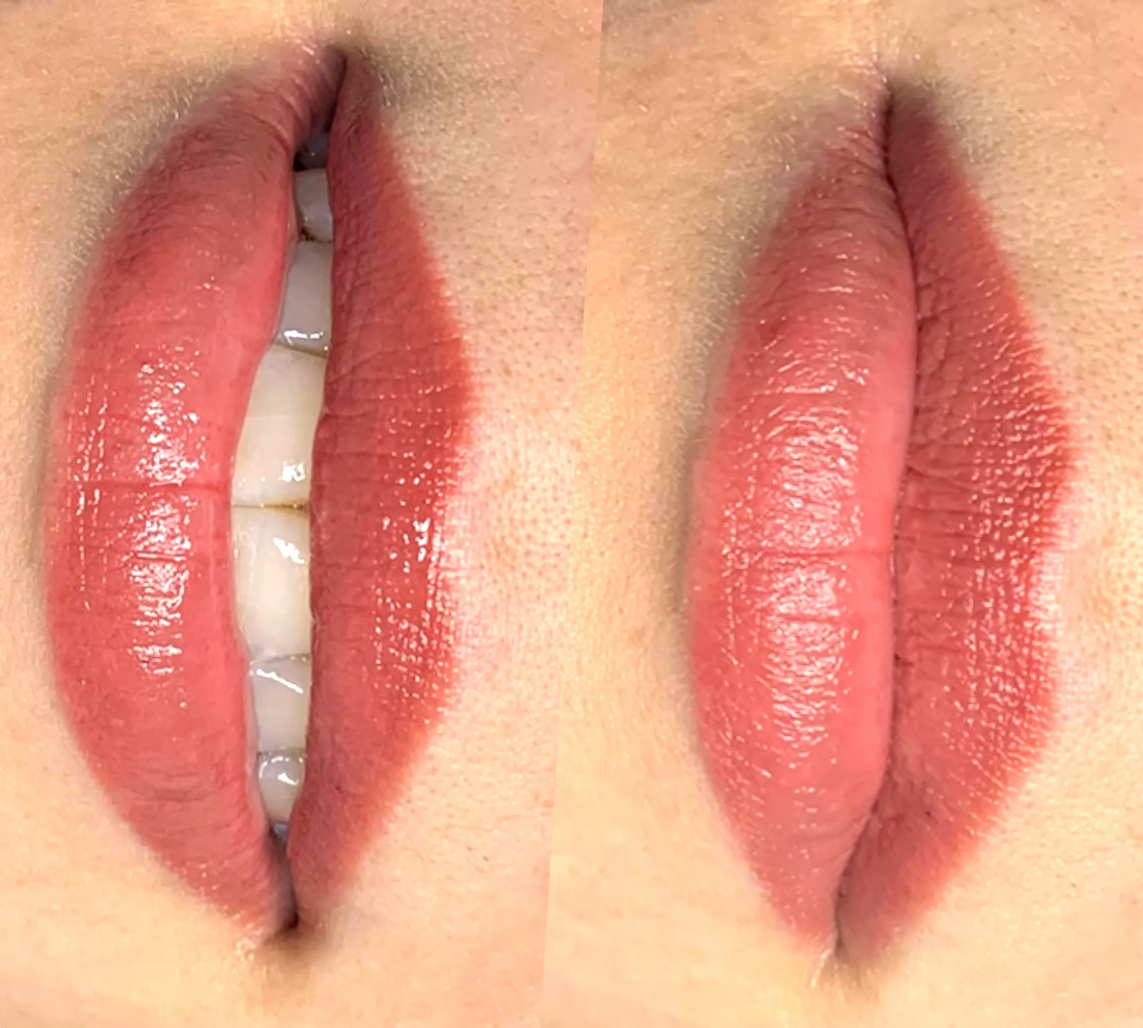 pigment loss peeling