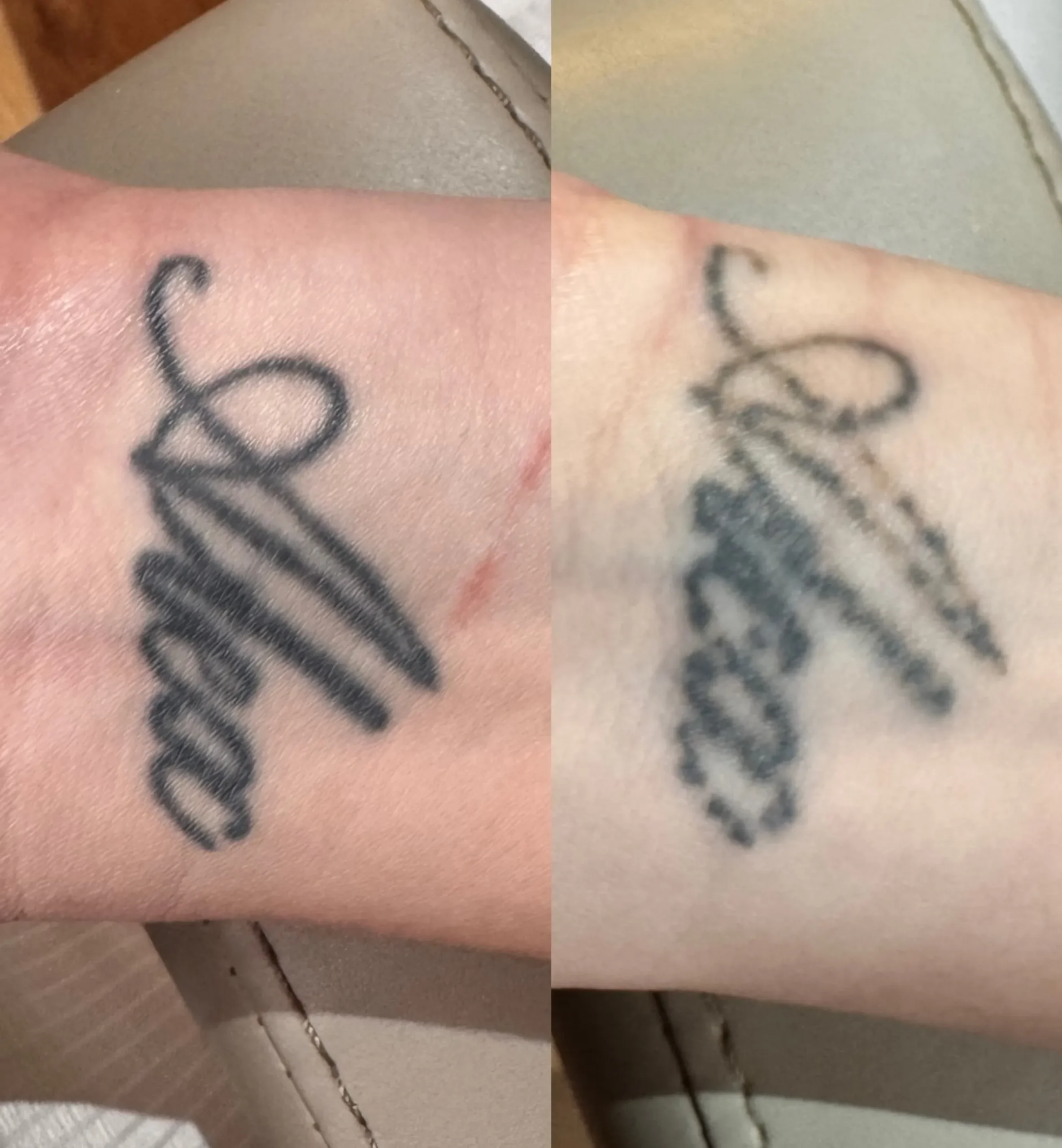 laser tattoo lightening brows