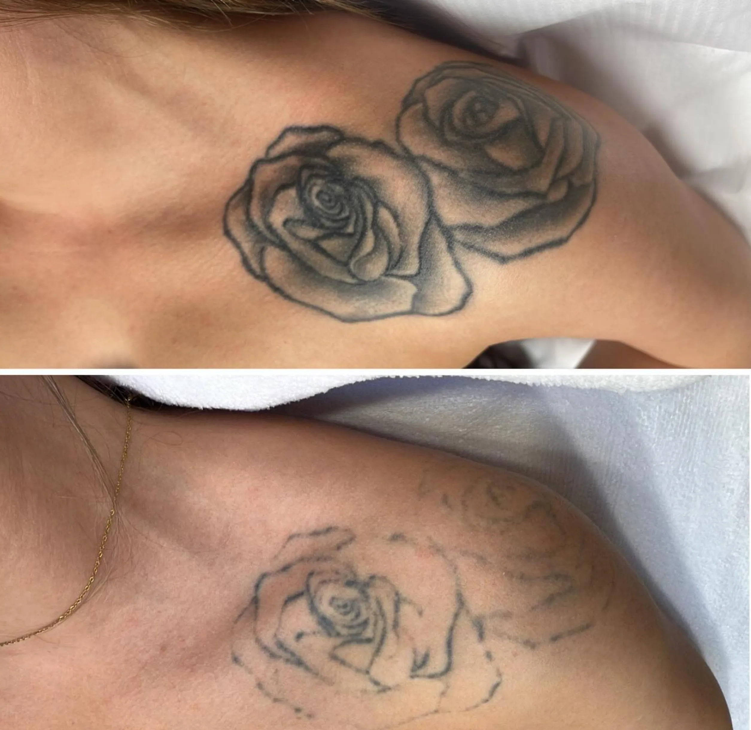 partial tattoo removal benefits