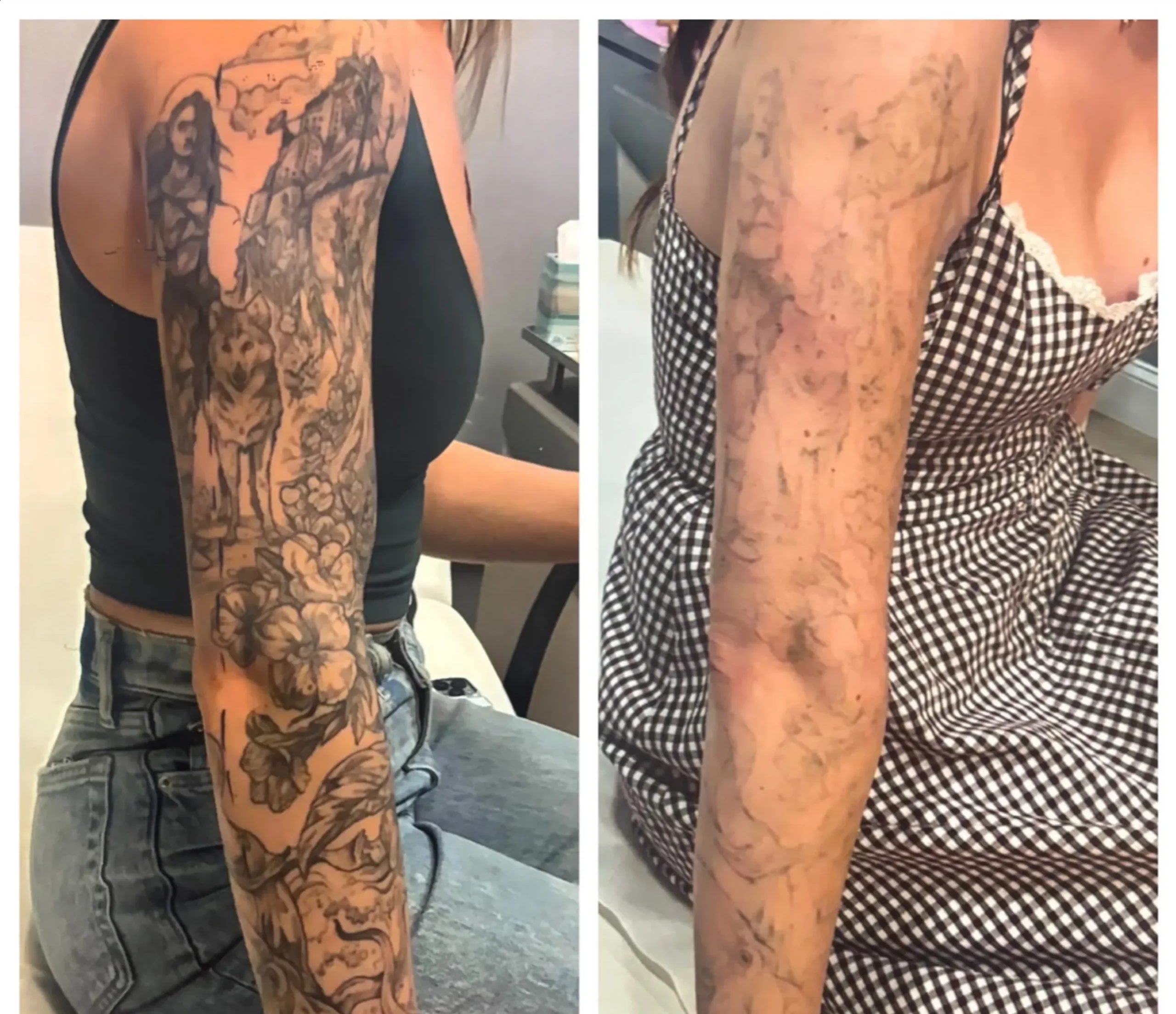 remove tattoo for cover up