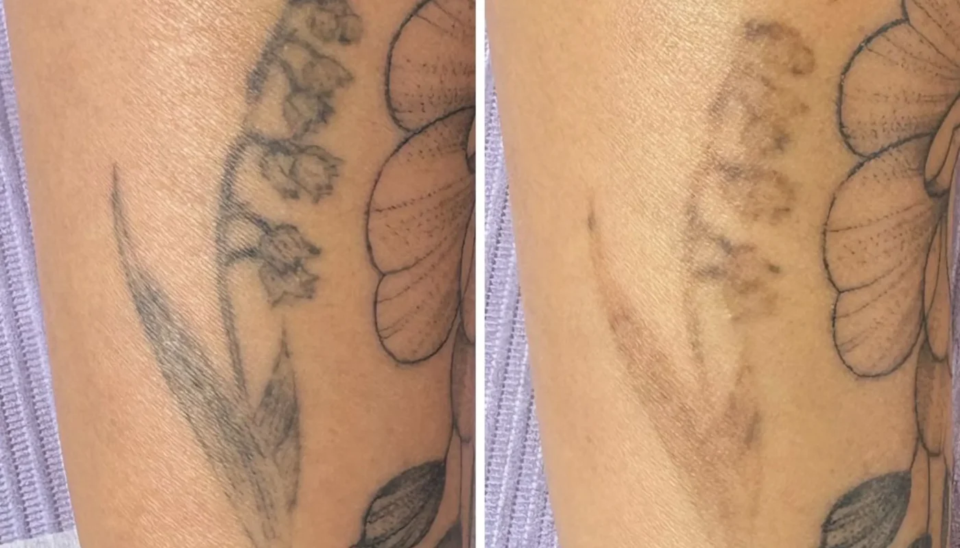 tattoo fading vs full removal